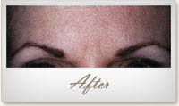 After BOTOX® treatment for frown lines
