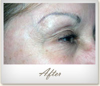 After BOTOX® treatment for crow's feet