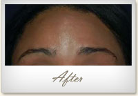 After BOTOX® treatment for forehead lines