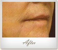 After treatment for wrinkles on the mouth and chin