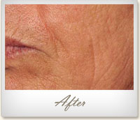 After treatment on facial wrinkles
