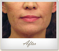 After laser skin tightening around the mouth and chin
