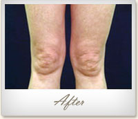 After laser skin tightening on the legs