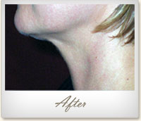 After Mesotherapy treatment on the chin