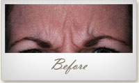 Before BOTOX® treatment for frown lines