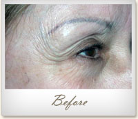Before BOTOX® treatment for crow's feet