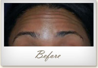 Before BOTOX® treatment for forehead lines