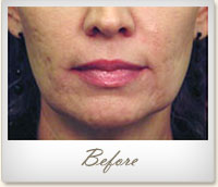 Before laser skin tightening around the mouth and chin
