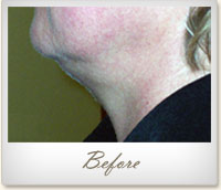 Before Mesotherapy treatment on the chin